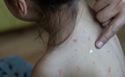 Sant&eacute; : acc&eacute;l&eacute;ration de la circulation du virus de la rougeole dans la r&eacute;gion